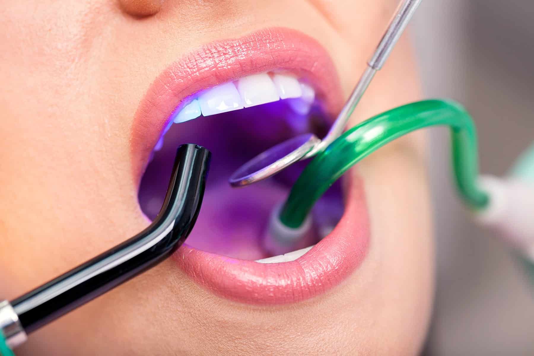 Dental fillings appointment in Thornton, CO