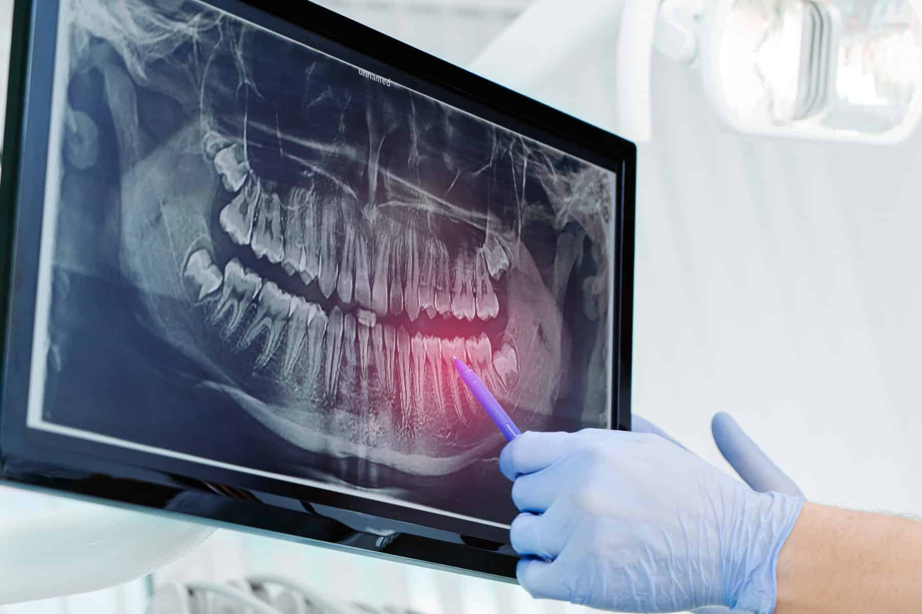 dental extractions in Thornton, CO from Hearthside Dentistry